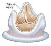 Tissue heart valve.